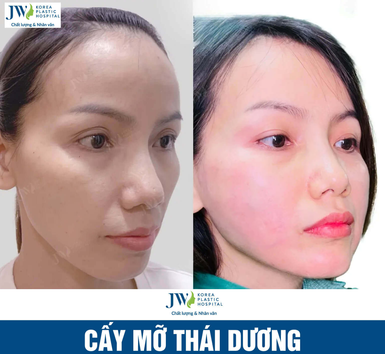 nhung-luu-y-cay-mo-thai-duong