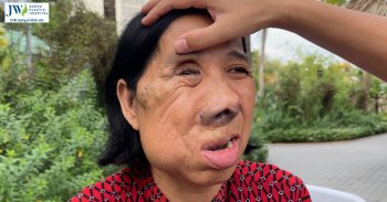 Cô Màng Miền Tây được Bác sĩ Tú Dung mổ từ thiện tái sinh gương mặt
