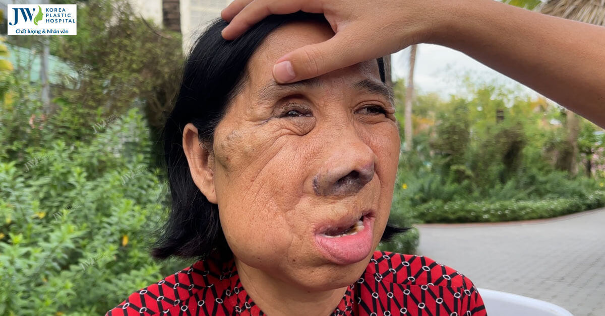 co mang mien tay khoi u