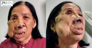 Cô Màng Miền Tây bị dị tật gương mặt suốt hơn 50 năm cầu cứu bác sĩ Tú Dung