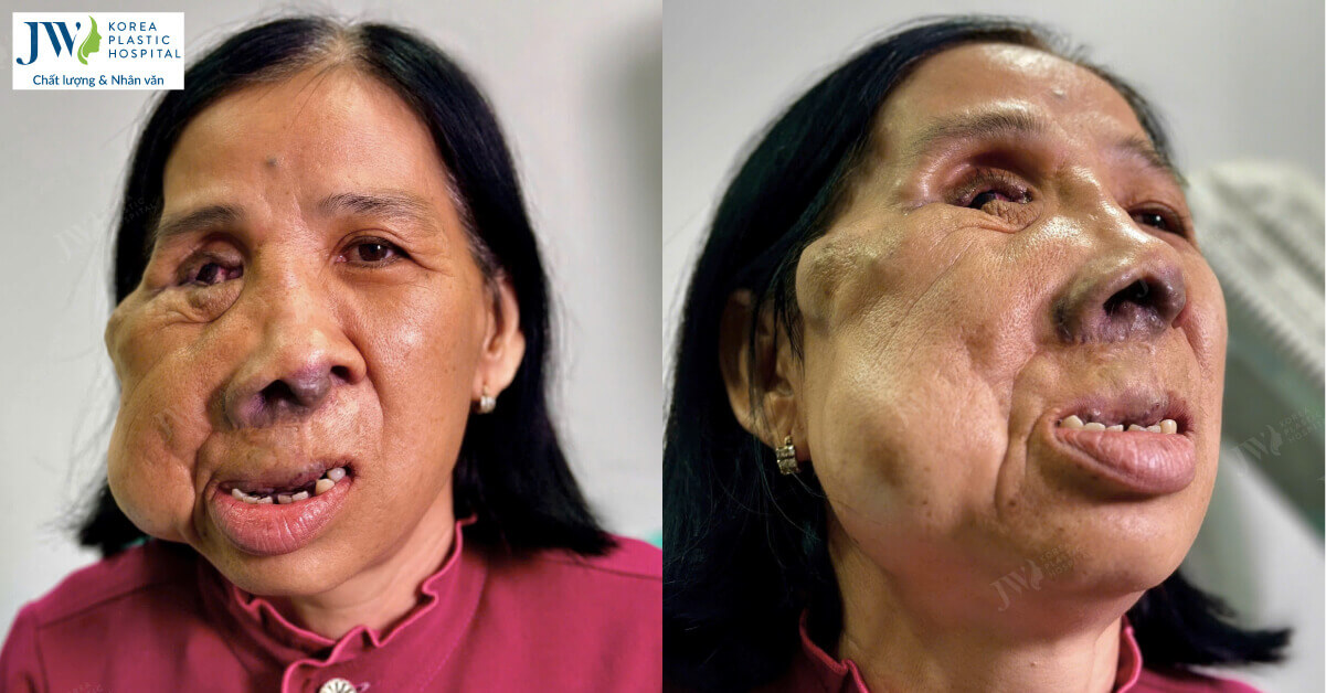 co mang mien tay bi di tat guong mat