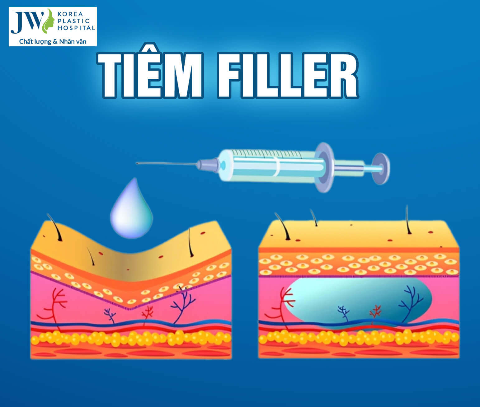 filler-hoat-dong-the-nao