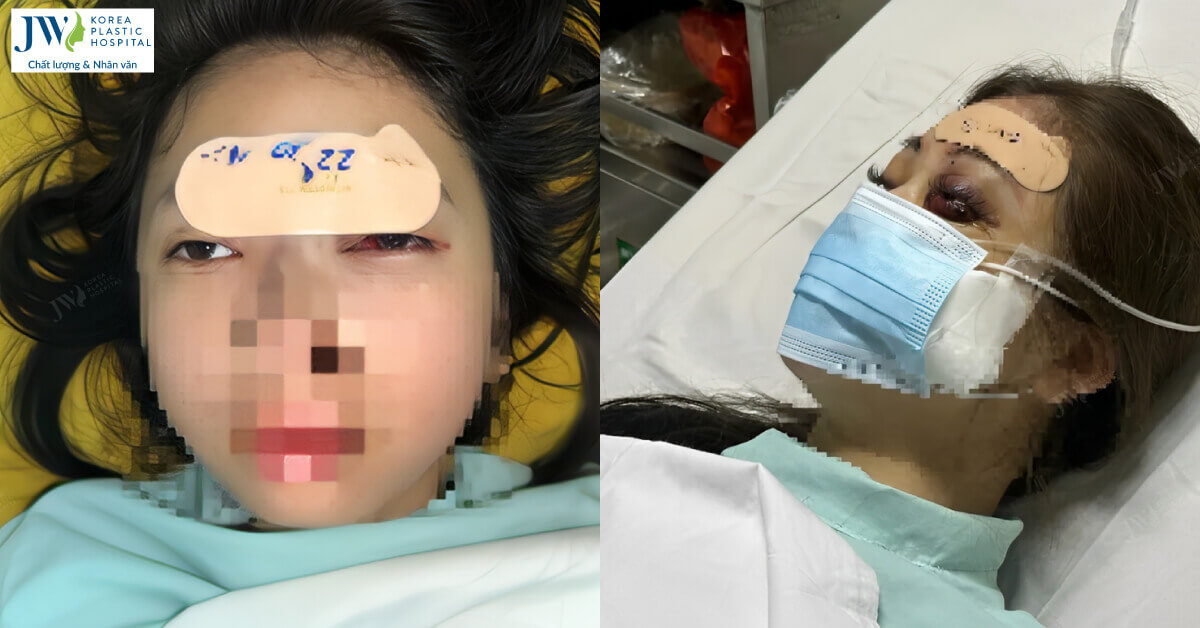 nu sinh 14 tuoi mu mat