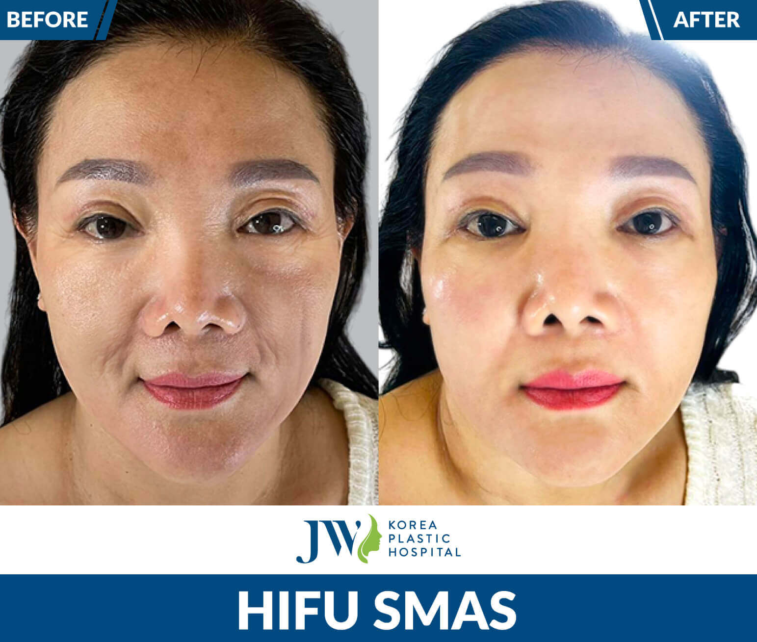 hifu-smas