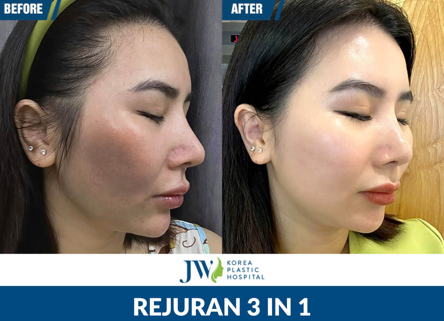 rejuran 3 in 1
