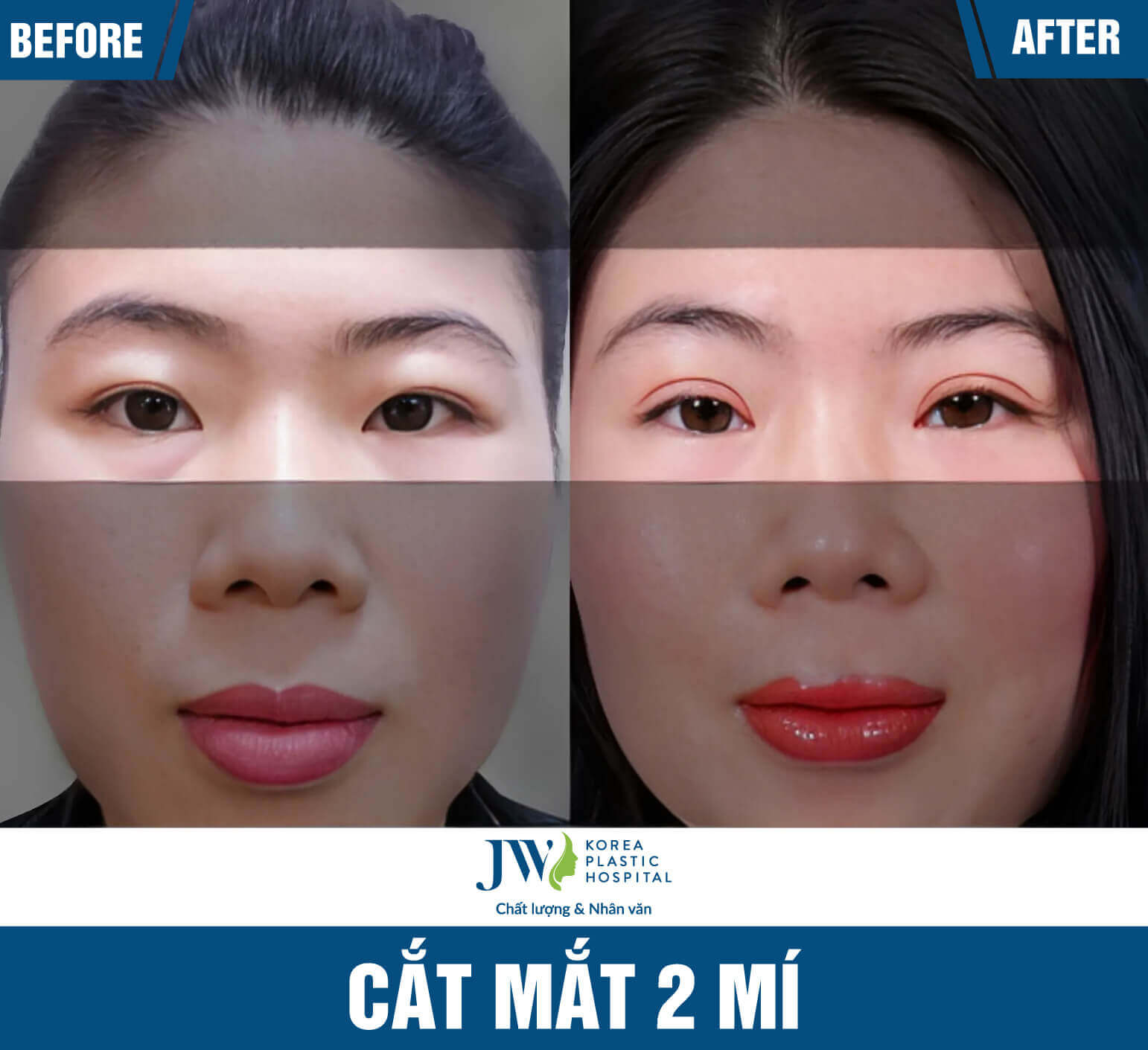 cắt mắt 2 mí
