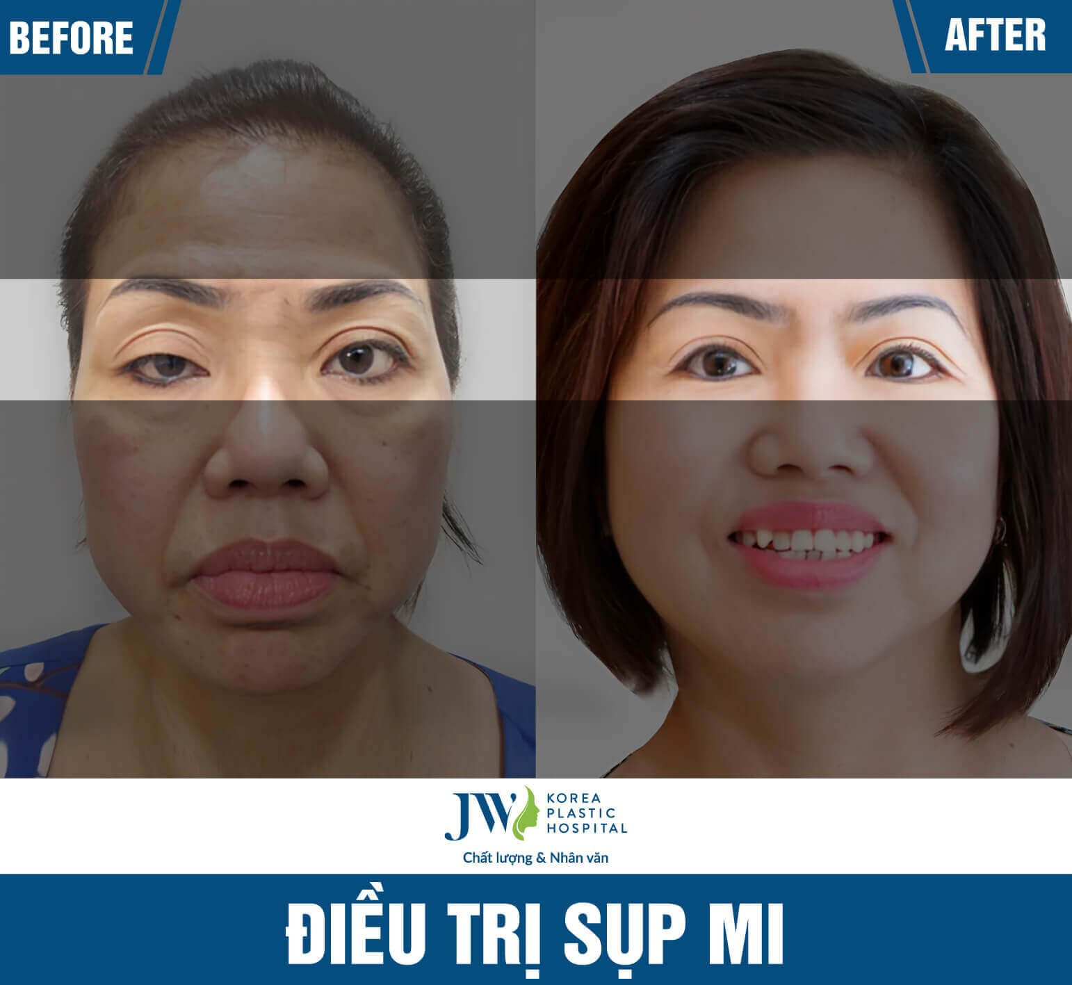 dieu-tri-sup-mi