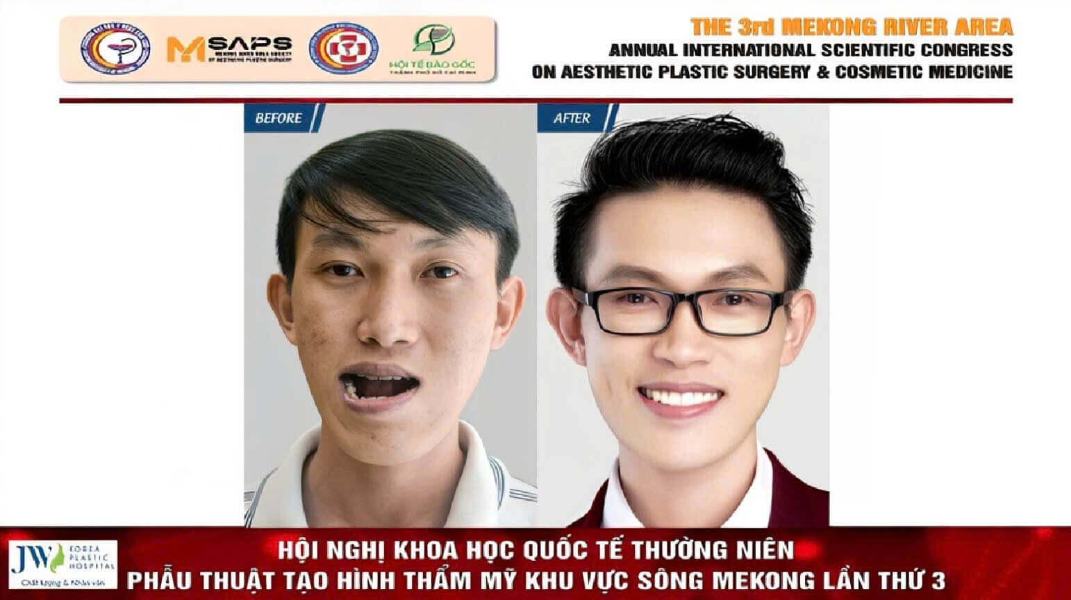 ke-qua-phau-thuat-ham-dieu-chinh-khop-can