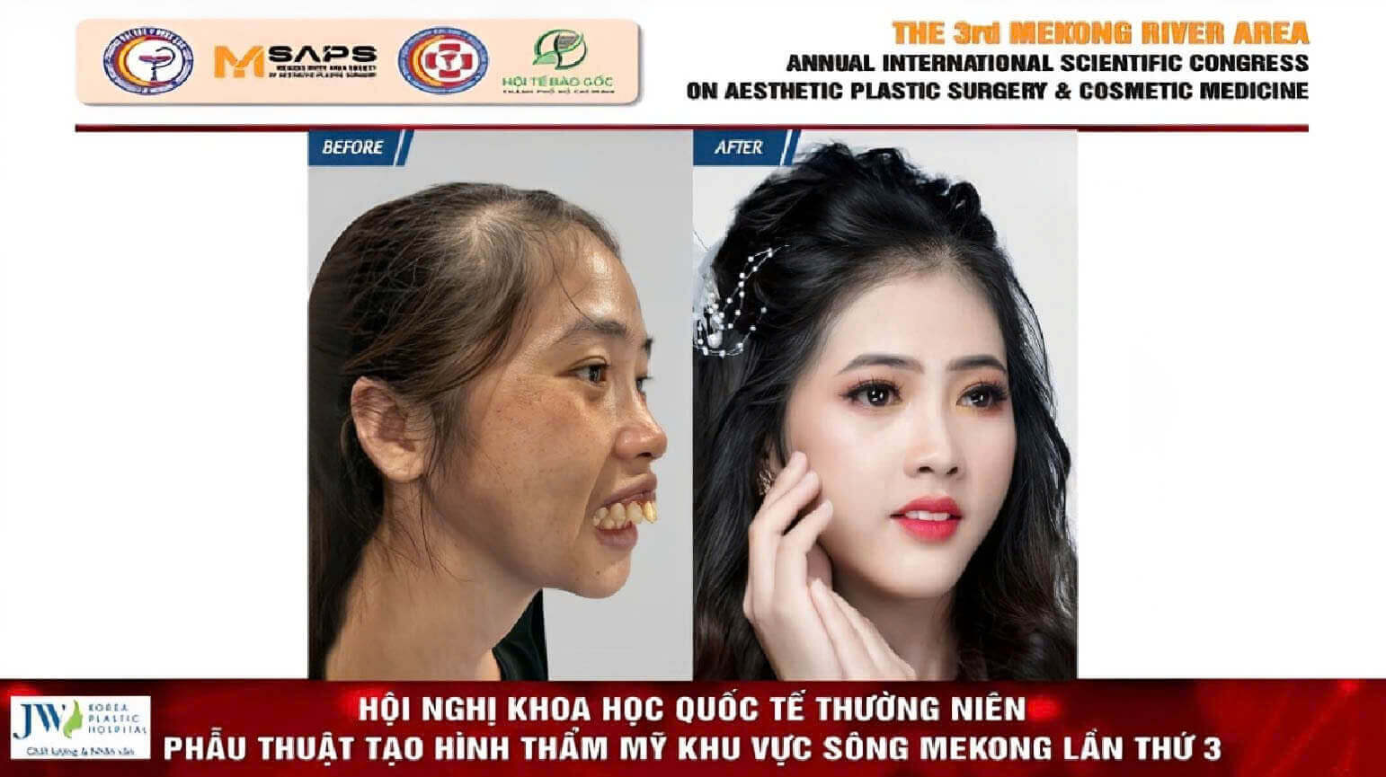 phau-thuat-ham-ho