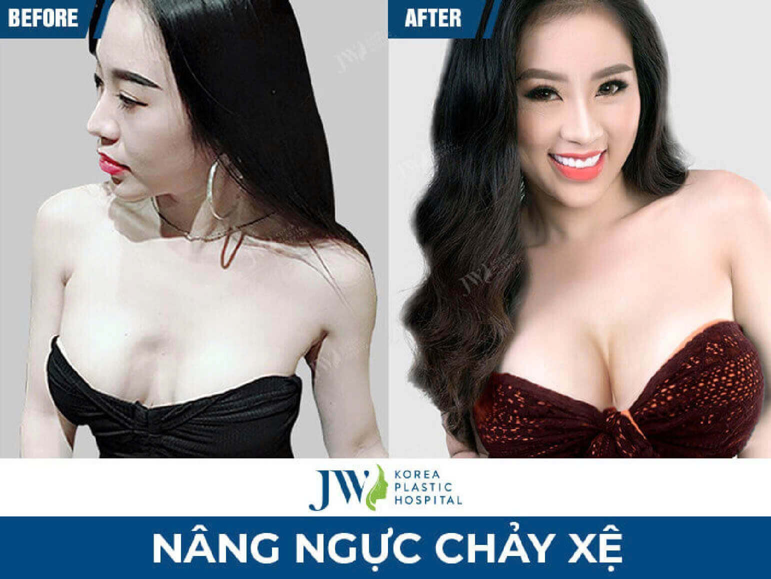 truoc-va-sau-nang-nguc-sa-tre
