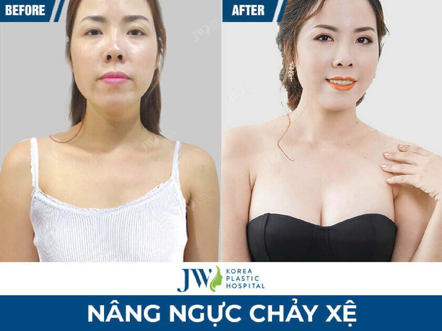 truoc-va-sau-nang-nguc