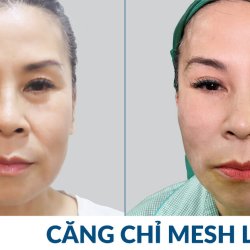 Căng chỉ Mesh Lift tại JW: Việt kiều U40 giật mình trẻ 20 tuổi