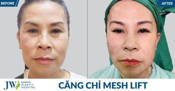 Căng chỉ Mesh Lift tại JW: Việt kiều U40 giật mình trẻ 20 tuổi