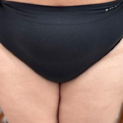 U mỡ khổng lồ 20 năm gây biến dạng đùi cô gái Mỹ gốc Việt
