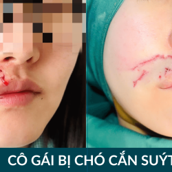 Bị chó cắn đứt miệng, cô gái Hàn Quốc cầu cứu Bệnh viện JW khâu môi