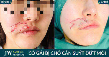 Bị chó cắn đứt miệng, cô gái Hàn Quốc cầu cứu Bệnh viện JW khâu môi