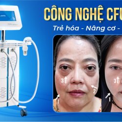 NÂNG CƠ – XÓA NHĂN – GIẢM MỠ VỚI CÔNG NGHỆ CFU 3 IN 1 VƯỢT TRỘI TẠI JW