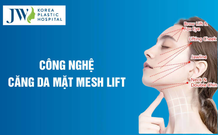 cong nghe mesh lift