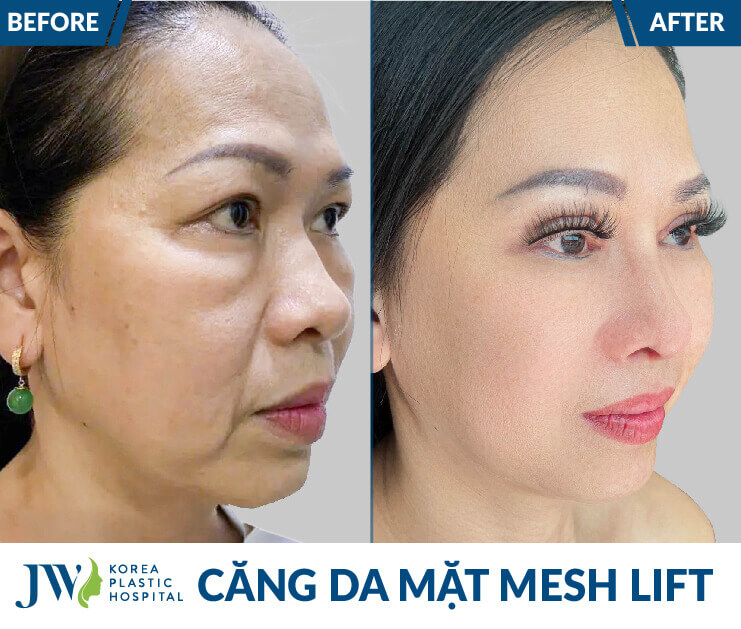 truoc va sau khi cang chi 2