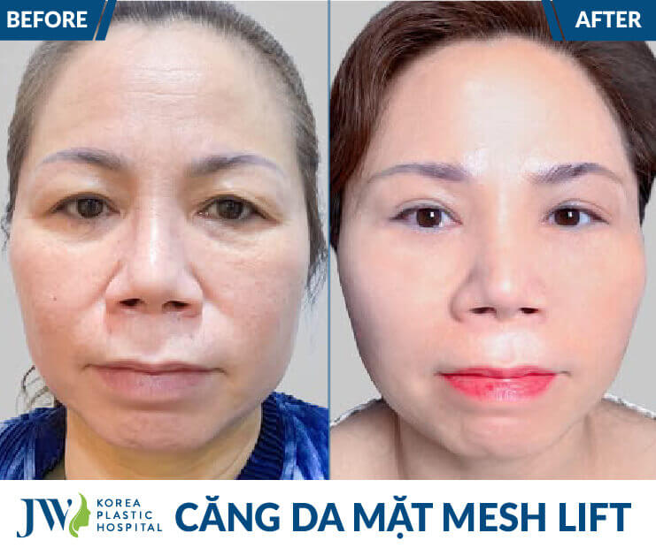 truoc va sau khi cang chi 3