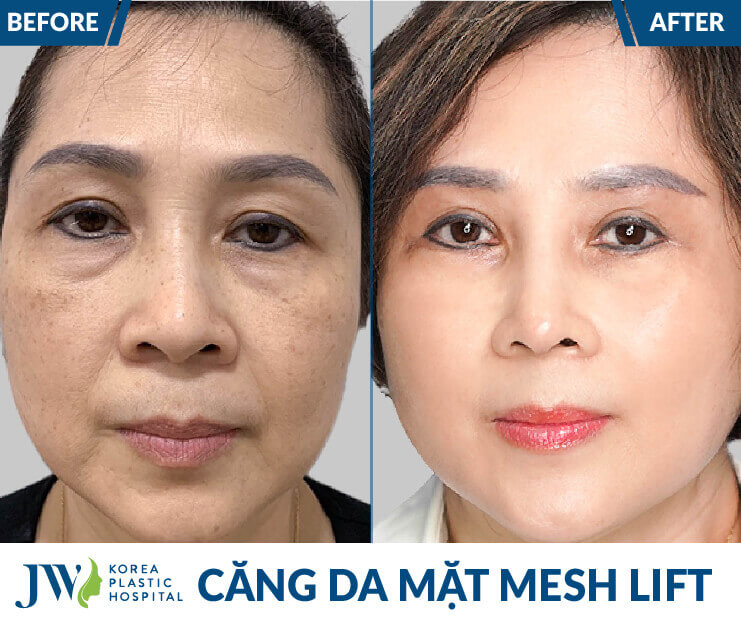 truoc va sau khi cang chi