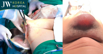 bien chung tiem filler