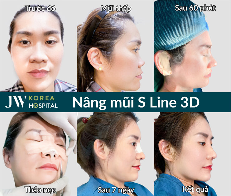 nang mui s line 3d tai cau truc toan bo mui 
