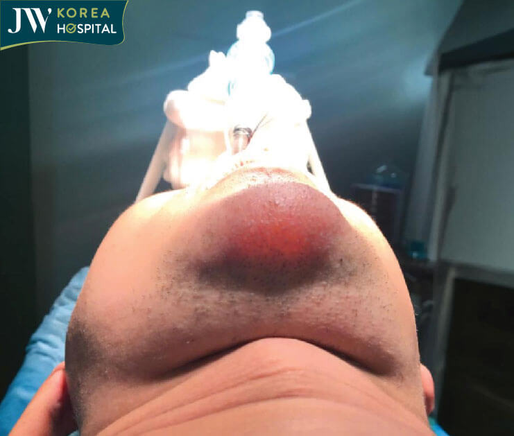 bien chung filler cam 1