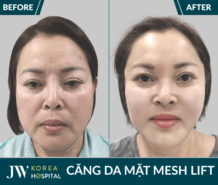 cang da mat mesh lift