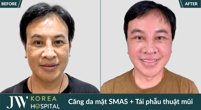 hinh truoc va sau cang da mat