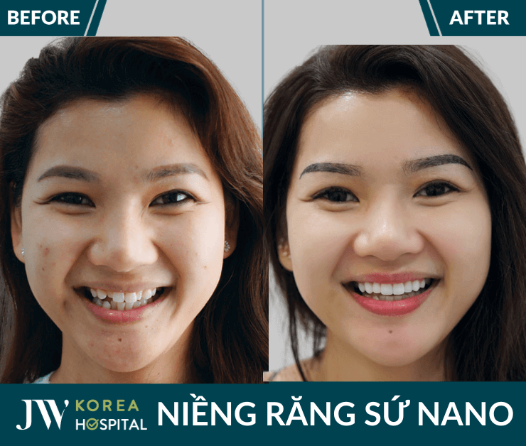 nieng rang su nano