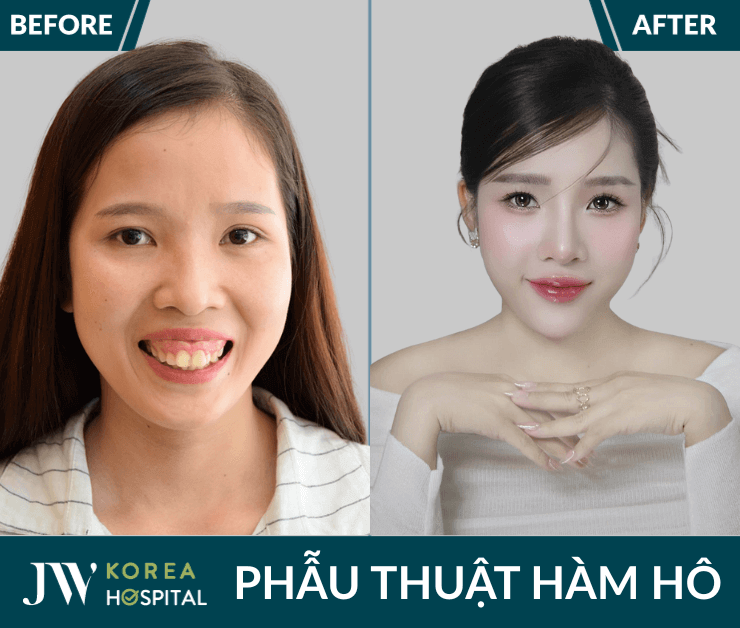 phau thuat ham ho