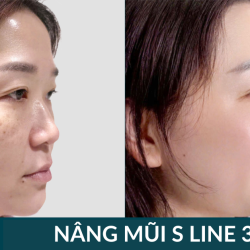Nâng Mũi S Line 3D – Công Nghệ Tái Tạo Dáng Mũi Chuẩn Tỷ Lệ Vàng