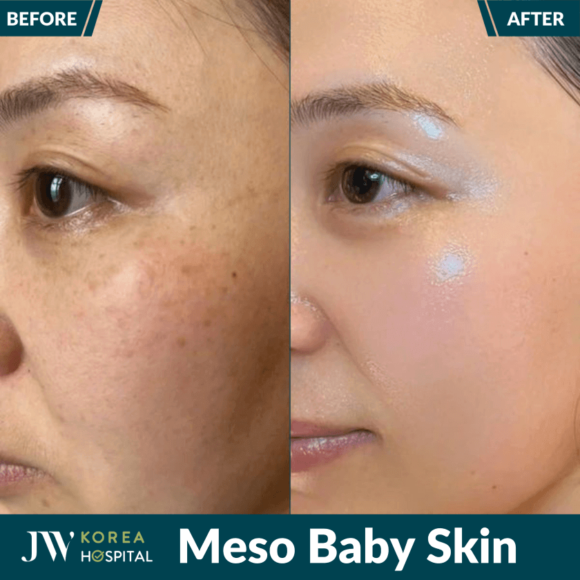 meso baby skin