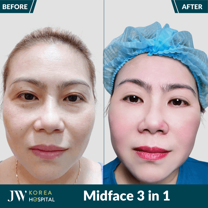 midface 3 in 1 