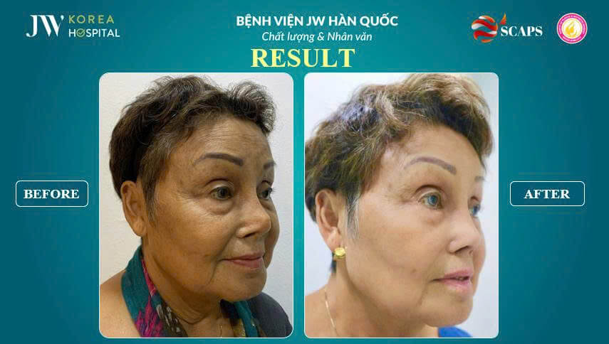 nang mui sun suon