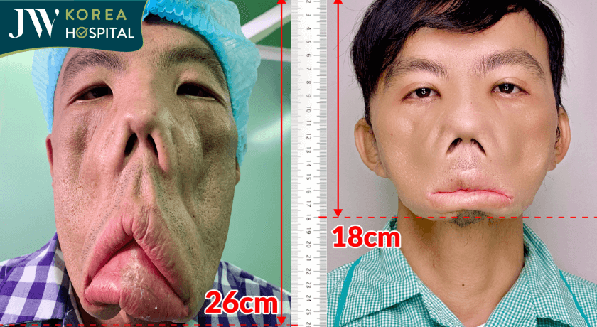 anh mến bệnh MRS trước và sau phẫu thuật