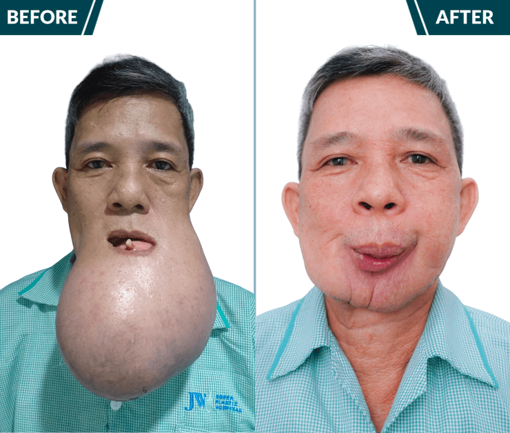 chú khanh trước và sau phẫu thuật