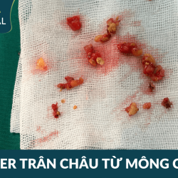 Tiêm filler giả: Cô gái Ê-đê trả giá đắt với hàng chục filler trân châu ở mông phải cầu cứu bác sĩ JW