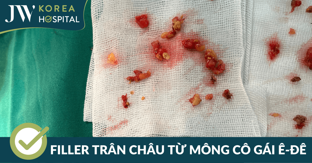 filler cua mong co gai e de