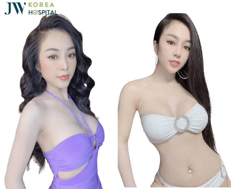 hình ảnh khách hàng nâng ngực tại bệnh viện jw