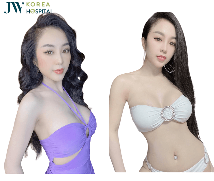 hinh anh khach hang sau nang nguc