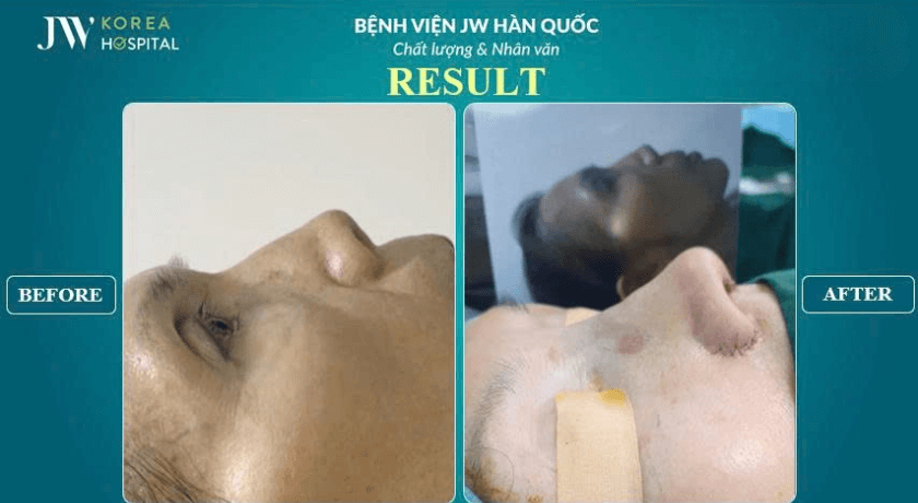hình ảnh trước và sau tái phẫu thuật mũi hỏng