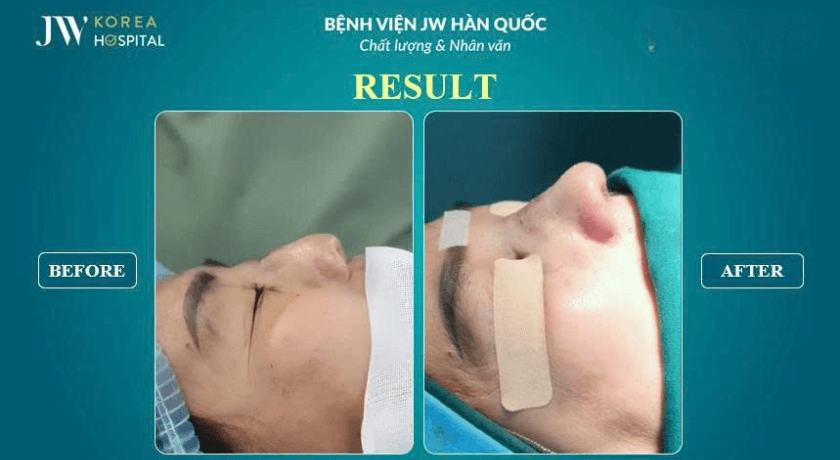 nâng mũi sụn sườn tái phẫu thuật mũi