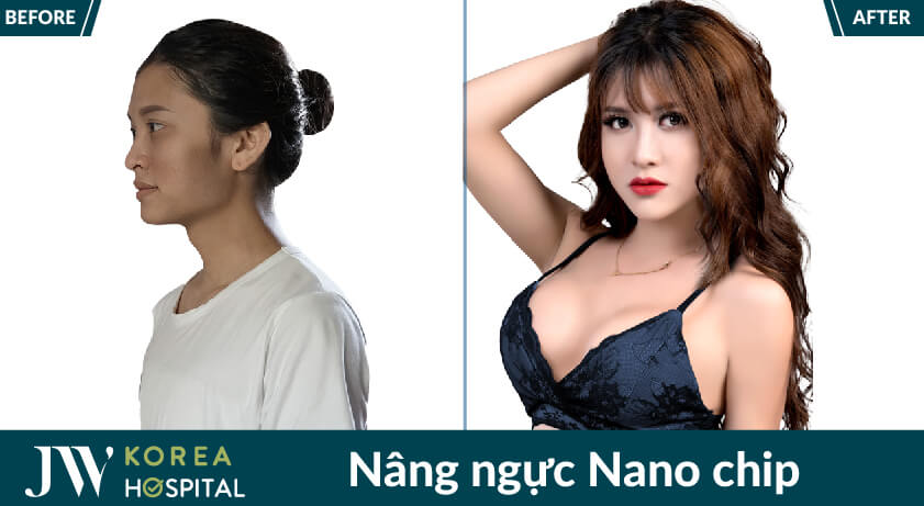 nang nguc Nano chip