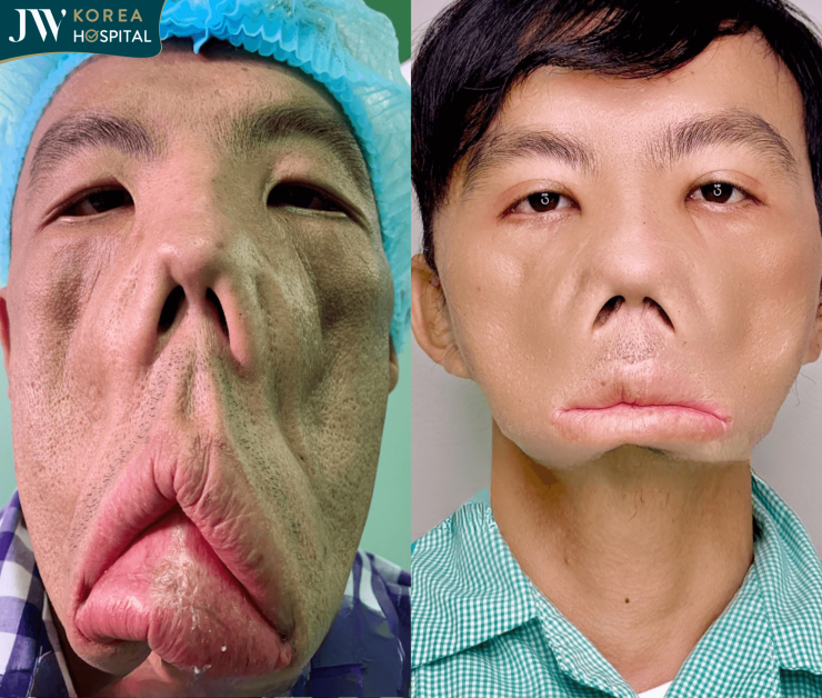 hình ảnh anh Mến trước và sau khi đến bệnh viện JW