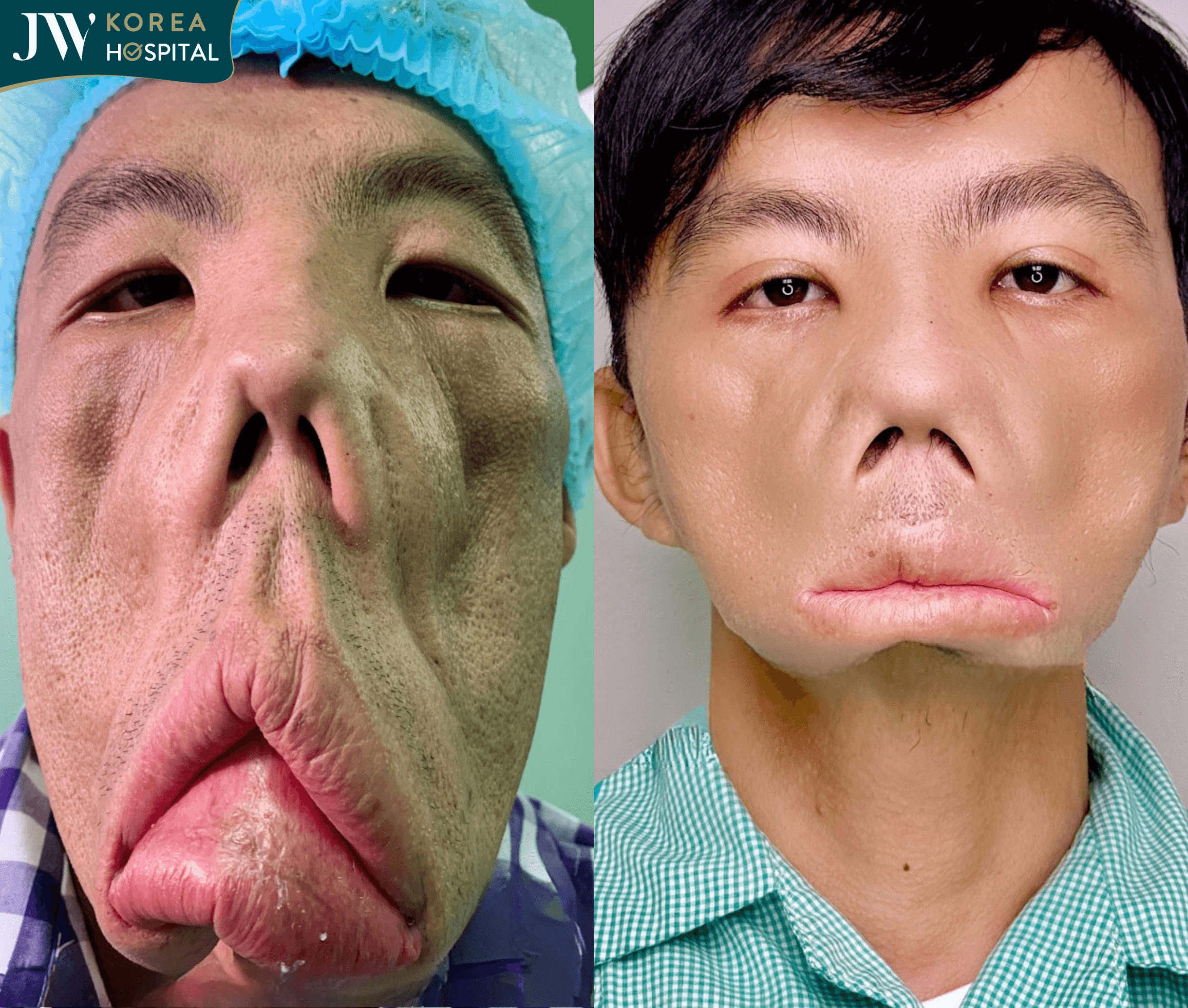 hình ảnh anh Mến trước và sau khi đến bệnh viện JW