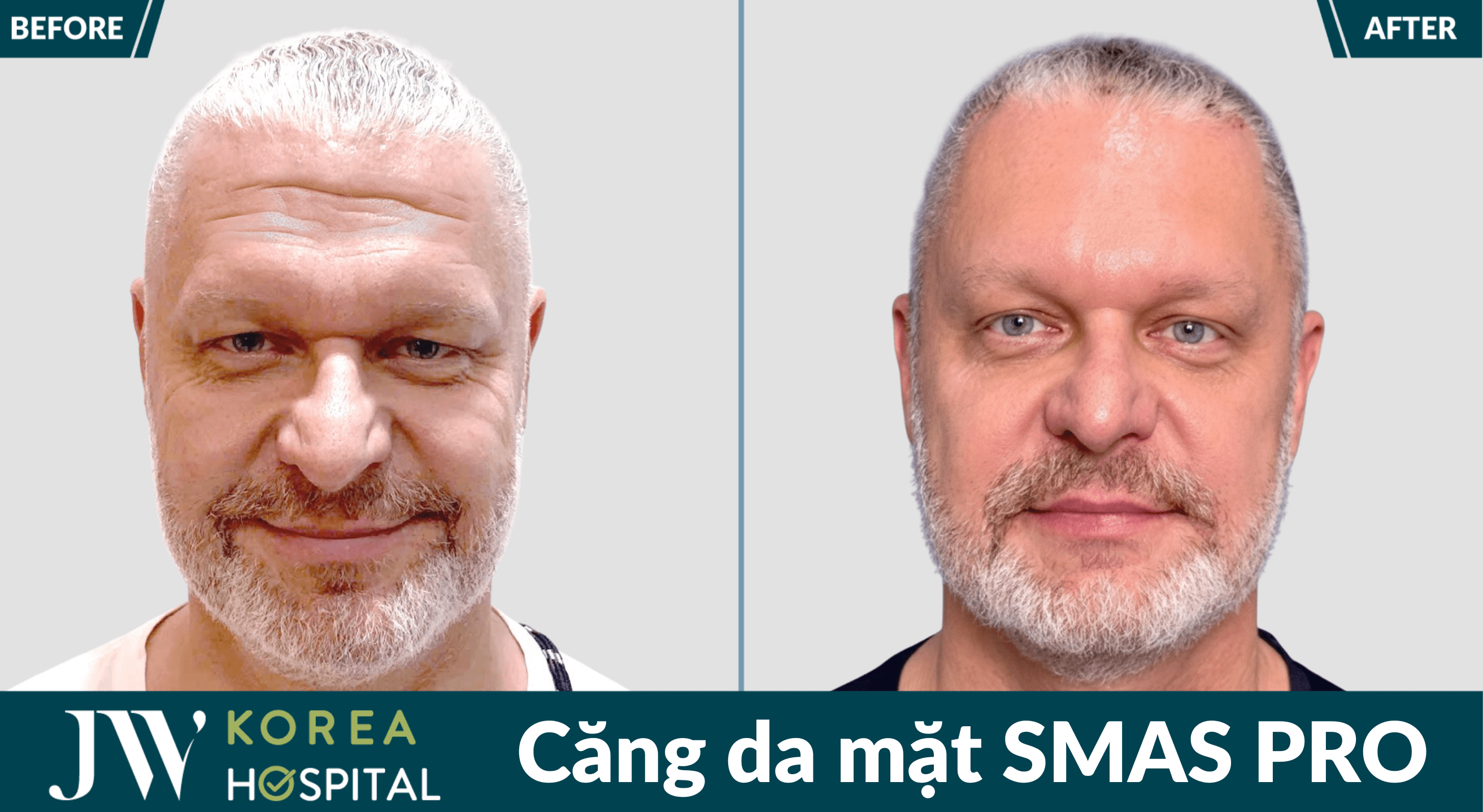 Trẻ ngay 20 tuổi với Căng da mặt SMAS PRO độc quyền tại Bệnh viện JW 