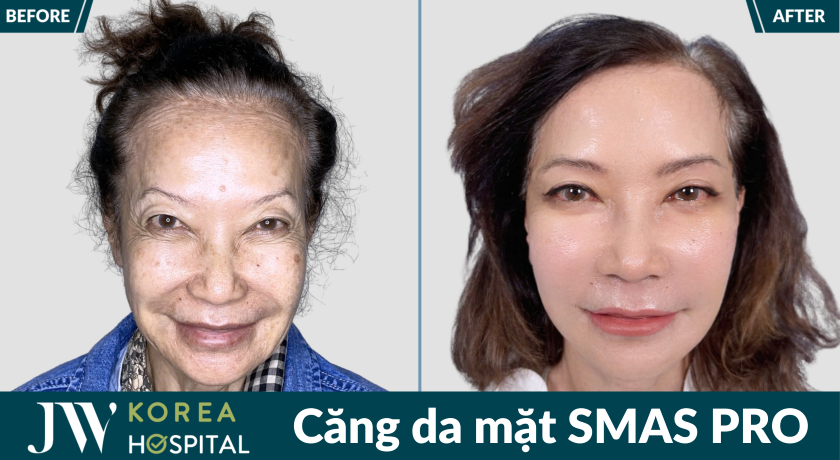 căng da mặt SMAS PRO là phương pháp giúp cải lão 20 tuổi độc quyền tại Bệnh viện JW 