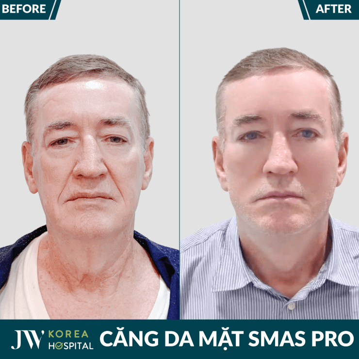 cang da mat smas pro giup tre lai 20 tuoi